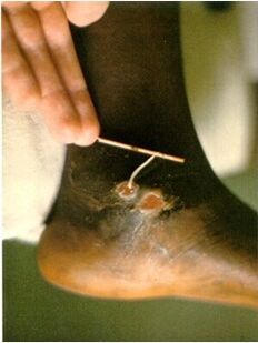 Guinea worm removed from the leg of a person suffering from dracunculia